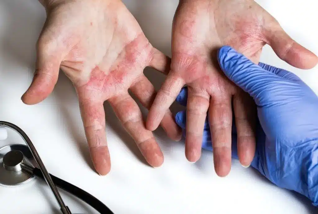 Mãos com bolhas de disidrose, sendo tratadas de forma natural